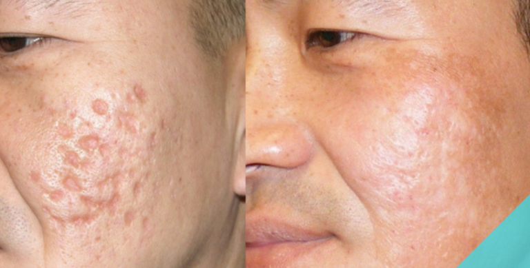 Acne Scar Treatment on Young Male